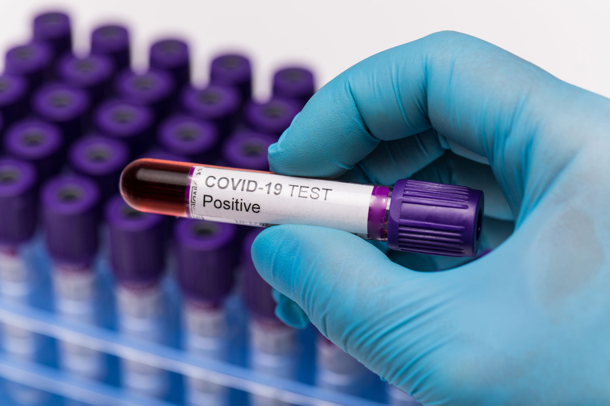 Sociálna poisťovňa radí: Ak sa Vám od roku 2020 zmenila výška príjmov, môžete požiadať o nové posúdenie pandemickej OČR